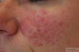 Rosacea